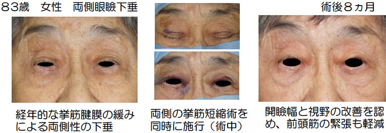 事例：83歳　女性　両側眼瞼下垂