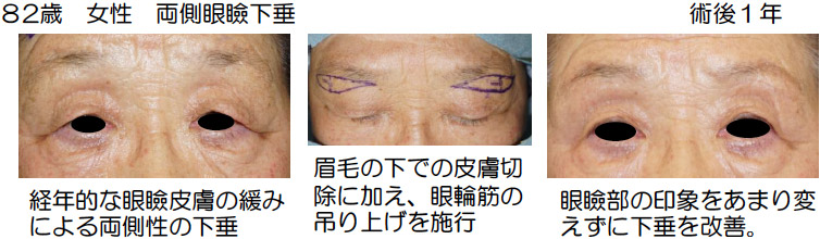 事例：82歳　女性　両側眼瞼下垂