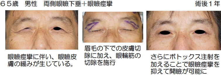 事例：65歳　男性　両側眼瞼下垂＋眼瞼痙攣