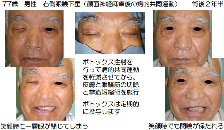 事例：77歳　男性　右側眼瞼下垂（顔面神経麻痺後の病的共同運動）